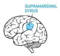 supramarginal gyrus tumor