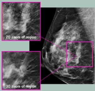Image of 3-D mammogram results