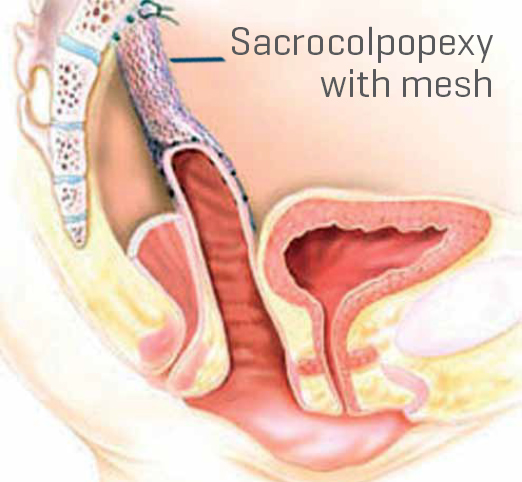 Minimally Invasive Surgery Offered to Treat Pelvic Prolapse