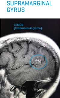 supramarginal gyrus lesion