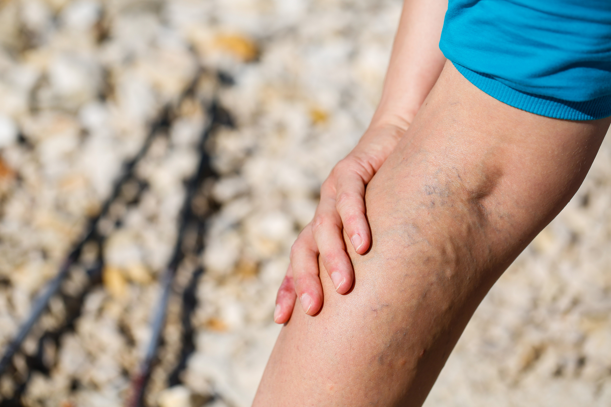 Do You Have Swelling and Pain in Your Legs? It May Be Deep Vein Thrombosis.