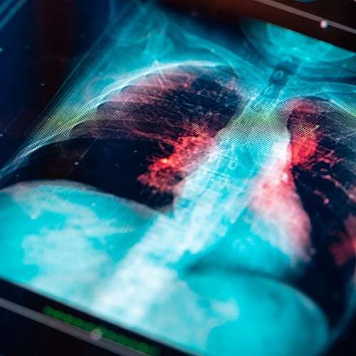 Catching Lung Cancer Early Could Save Your Life