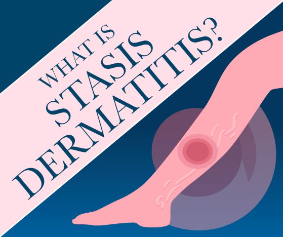 What is Stasis Dermatitis?
