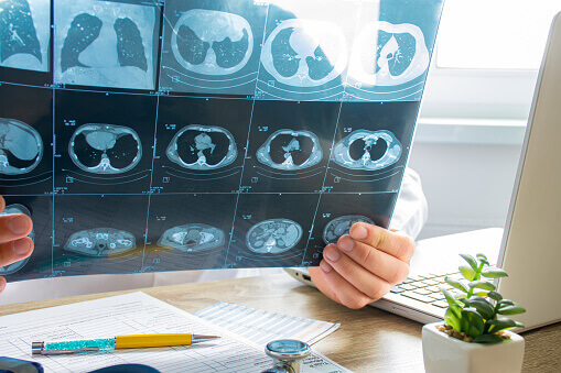 CT-scan of Lungs