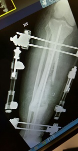 x-ray of rods in leg