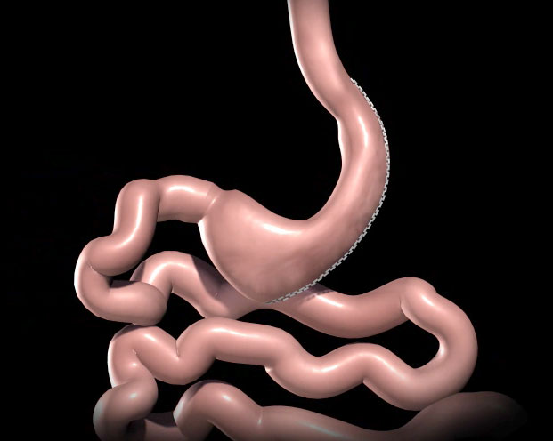 BariatricSurgery - Sleeve Gastrectomy video thumbnail