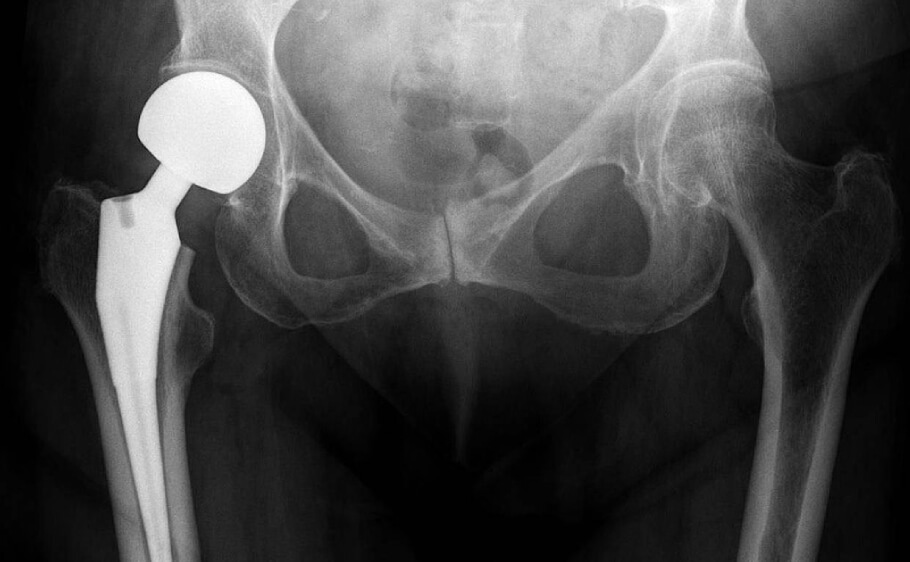 hip replacment x-ray