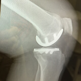 Partial knee replacement