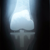 Total knee replacement x-ray