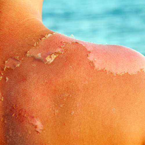 Don’t Get Burned! Easy Ways to Protect Your Skin This Summer