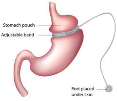 adjustable gastric band