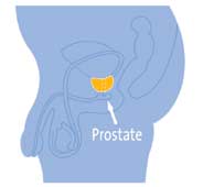 davinci prostatectomy