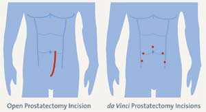 Prostatectomy incisions