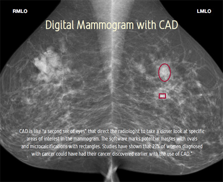 Digital mammogram with CAD