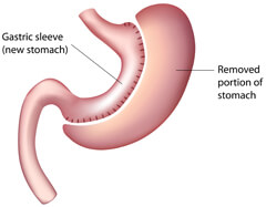 gastric sleeve